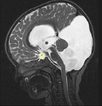 Beyin Omurilik Sıvısı Özellikleri ve Faydaları Nelerdir?