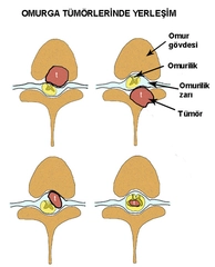 Omurilik Tümörü Belirtileri ve Tedavisi